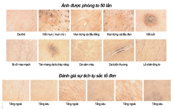 Hình ảnh da mặt phóng đại 50 lần từ máy soi da CF685 hiển thị trên màn hình máy tính